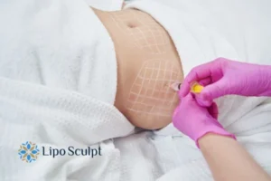 Are The Results From Aqualyx Permanent? 1 Do you want to know how long Aqualyx Hackney results last?