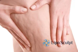 CoolSculpting for Legs: The Innovative Approach to Redefining Your Legs 5 Start your journey today book your coolsculpting treatment Hackney online today!