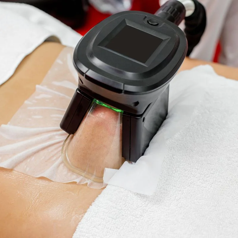 Fat Freezing treatment Hackney